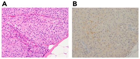 Lead figure from "Targeting the NTRK Fusion Gene in Pancreatic Acinar Cell Carcinoma: A Case Report and Review of the Literature" (Journal of the National Comprehensive Cancer Network, 2021)
